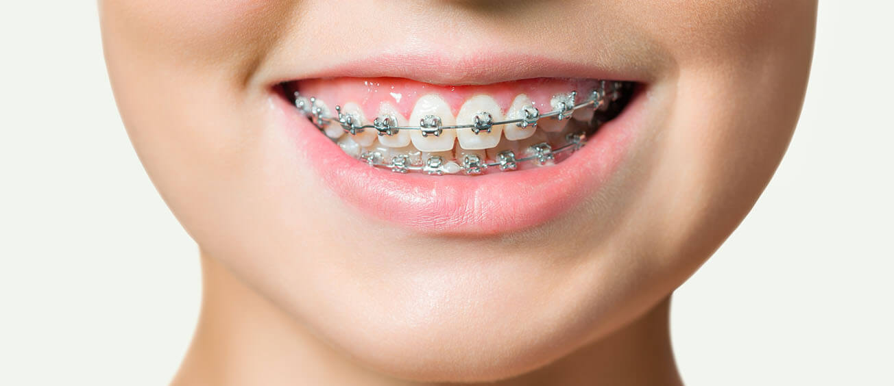 Braces: Cost, Process, Appointments, and Treatment Length Explained