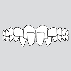 Crossbite (front teeth)